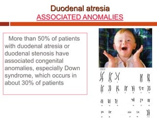More than 50% of patients
with duodenal atresia or
duodenal stenosis have
associated congenital
anomalies, especially Down
syndrome, which occurs in
about 30% of patients
Duodenal atresia
ASSOCIATED ANOMALIES
 