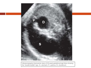 Ultrasonography (transverse view) of 24-week gestational age fetus showing
the “double bubble” sign. S—stomach, P—pylorus, D—duodenum
 