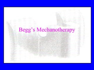 Begg’s Mechanotherapy
 