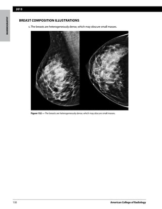 2013
130	 American College of Radiology		
MAMMOGRAPHY
BREAST COMPOSITION ILLUSTRATIONS
	 c.The breasts are heterogeneously dense, which may obscure small masses.
Figure 152 — The breasts are heterogeneously dense, which may obscure small masses.
 