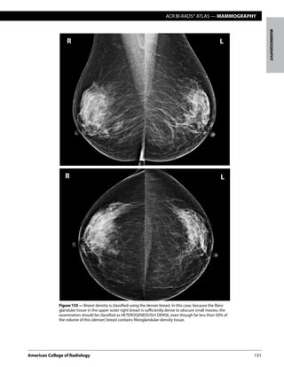 ACR BI-RADS® ATLAS — MAMMOGRAPHY
American College of Radiology	131
MAMMOGRAPHY
Figure 153 — Breast density is classified using the denser breast. In this case, because the fibro-
glandular tissue in the upper outer right breast is sufficiently dense to obscure small masses, the
examination should be classified as HETEROGENEOUSLY DENSE, even though far less than 50% of
the volume of this (denser) breast contains fibroglandular-density tissue.
 