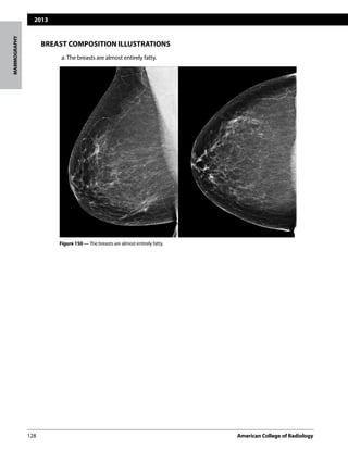 2013
128	 American College of Radiology		
MAMMOGRAPHY
BREAST COMPOSITION ILLUSTRATIONS
	 a.The breasts are almost entirely fatty.
Figure 150 — The breasts are almost entirely fatty.
 