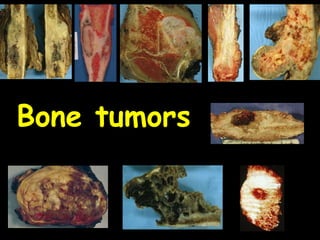 1
Bone tumors
 