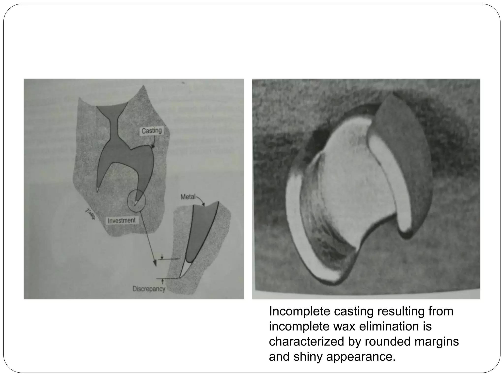 Incomplete casting resulting from
incomplete wax elimination is
characterized by rounded margins
and shiny appearance.
 