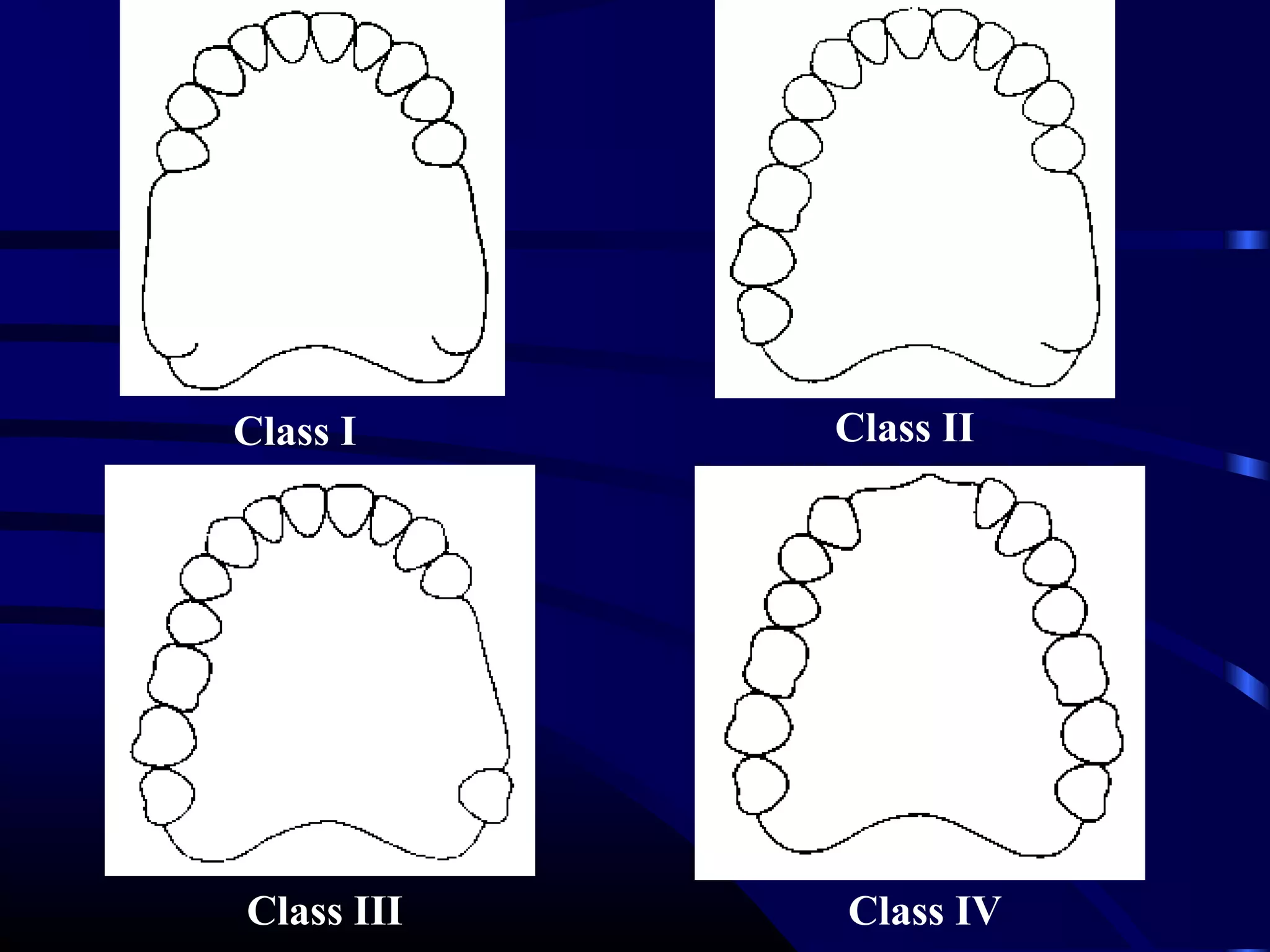 02 classification and indications of rpd | PPT