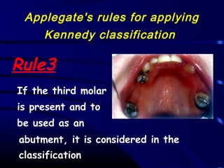 Applegate Classification 02 classification and indications of rpd | PPT