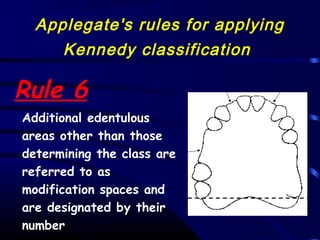 Applegate Classification 02 classification and indications of rpd | PPT