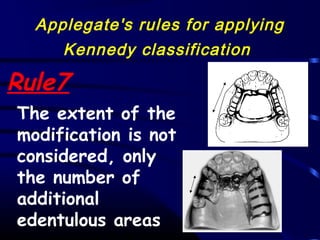 Applegate Classification 02 classification and indications of rpd | PPT