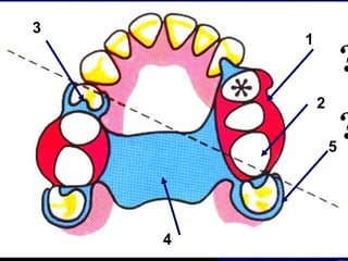 02 classification and indications of rpd | PPT