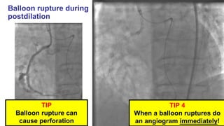 A brief review of complications and tips and tricks | PPTX