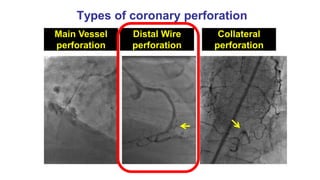 Perforation Classification A brief review of complications and tips and tricks | PPTX