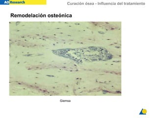 Curación ósea - Influencia del tratamiento
Giemsa
Remodelación osteónica
 