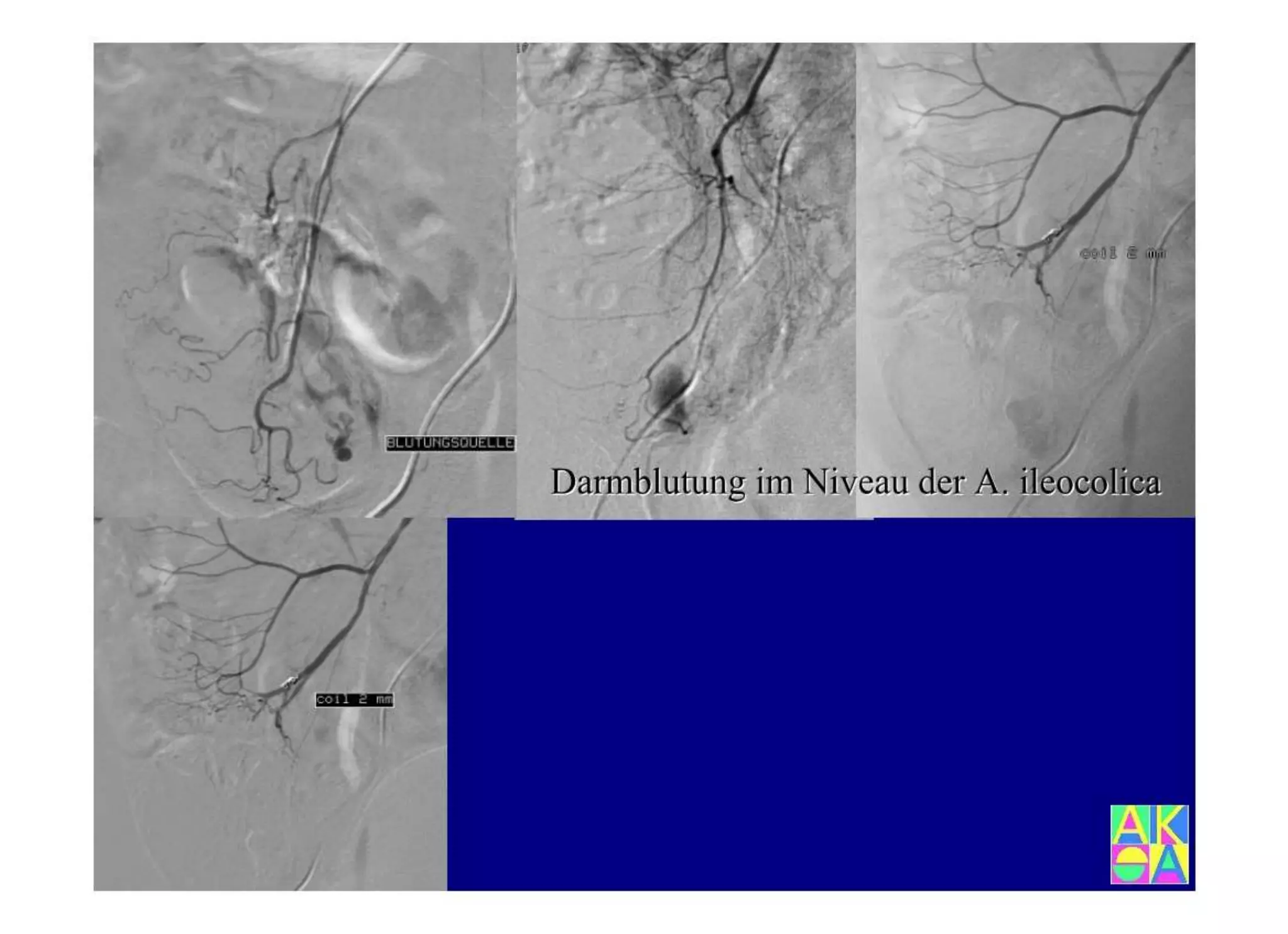 15.502 Darmerkrankungen, Ileus und akutes Abdomen.