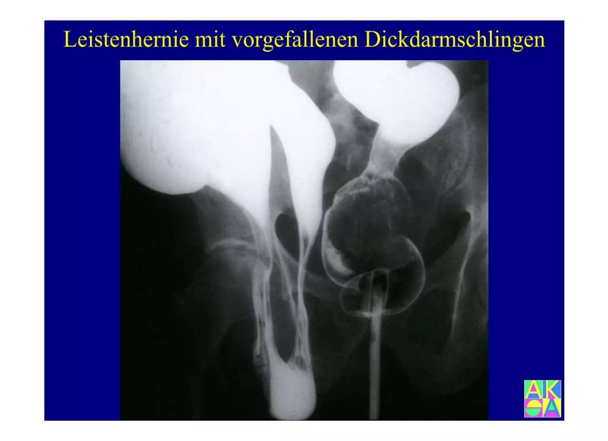15.502 Darmerkrankungen, Ileus und akutes Abdomen.