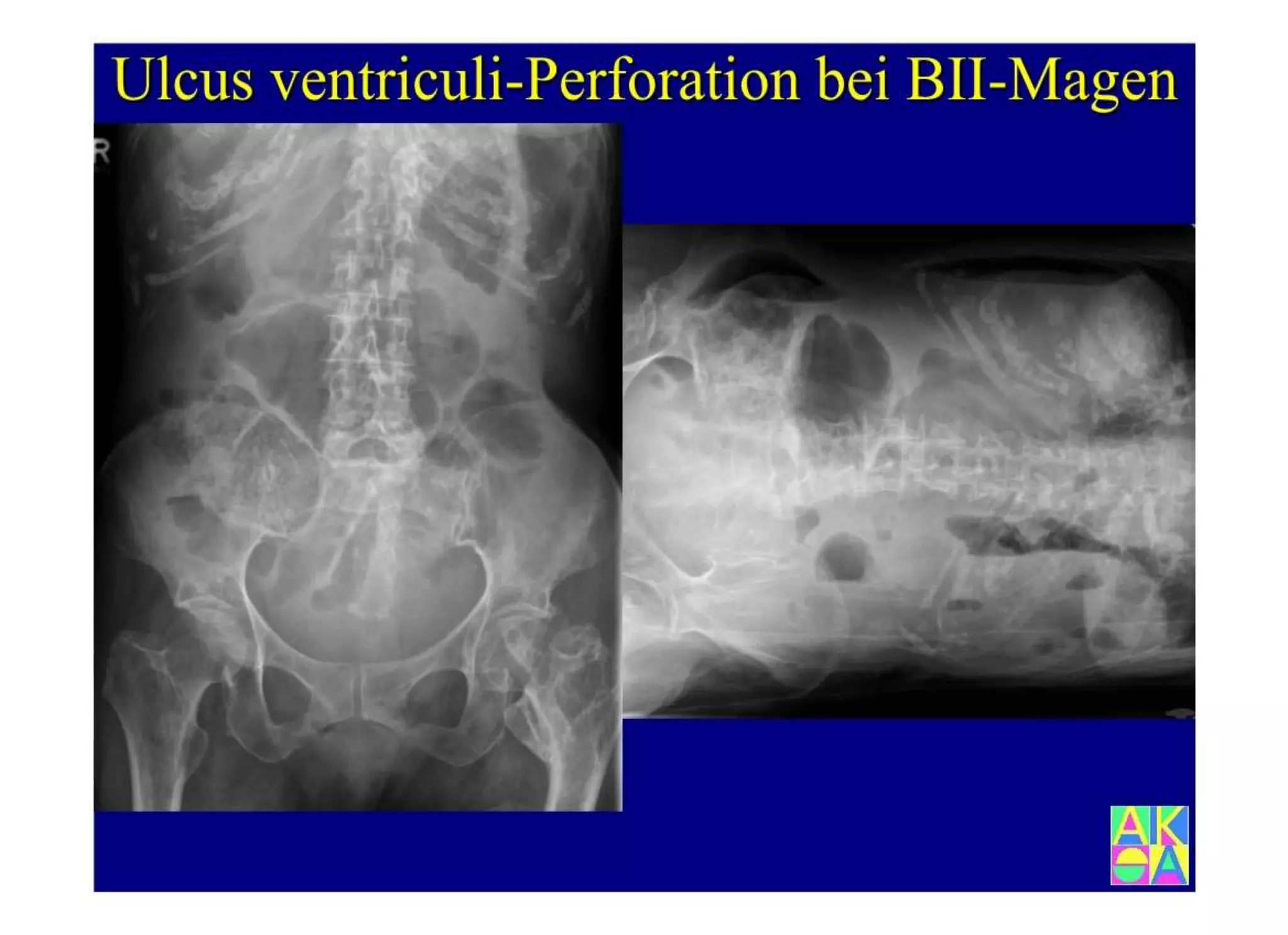 15.502 Darmerkrankungen, Ileus und akutes Abdomen.