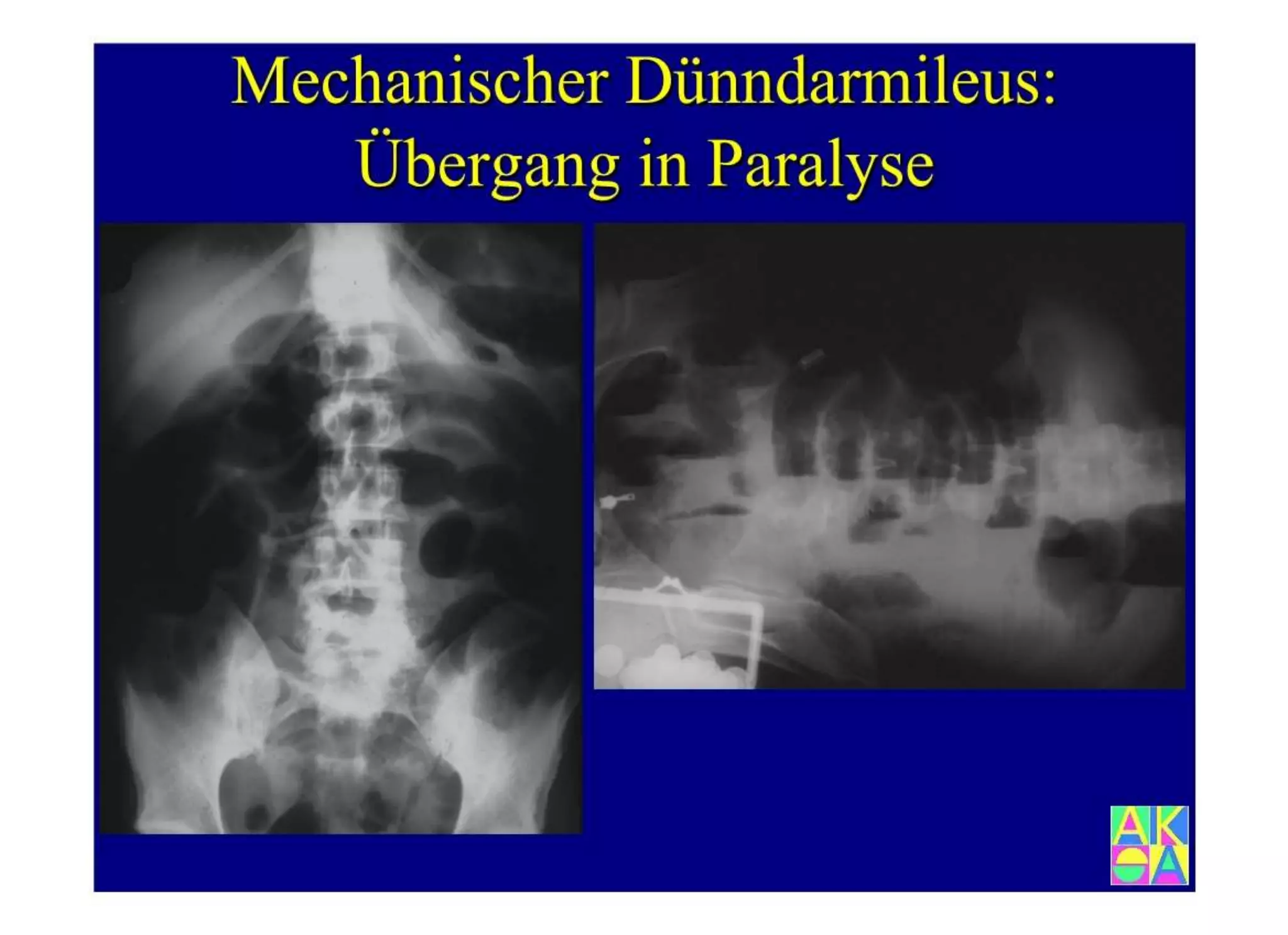 15.502 Darmerkrankungen, Ileus und akutes Abdomen.