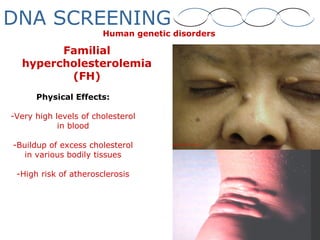 Familial
hypercholesterolemia
(FH)
Physical Effects:
-Very high levels of cholesterol
in blood
-Buildup of excess cholesterol
in various bodily tissues
-High risk of atherosclerosis
Human genetic disorders
DNA SCREENING
 