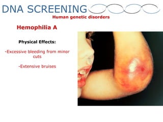 Hemophilia A
Physical Effects:
-Excessive bleeding from minor
cuts
-Extensive bruises
Human genetic disorders
DNA SCREENING
 