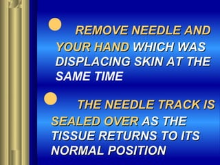  REMOVE NEEDLE ANDREMOVE NEEDLE AND
YOUR HANDYOUR HAND WHICH WASWHICH WAS
DISPLACING SKIN AT THEDISPLACING SKIN AT THE
SAME TIME
 THE NEEDLE TRACK ISTHE NEEDLE TRACK IS
SEALED OVERSEALED OVER AS THEAS THE
TISSUE RETURNS TO ITSTISSUE RETURNS TO ITS
NORMAL POSITIONNORMAL POSITION
 