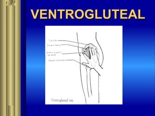 VENTROGLUTEALVENTROGLUTEAL
 