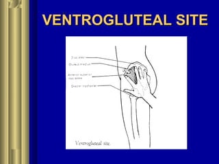V
VENTROGLUTEAL SITEVENTROGLUTEAL SITE
 