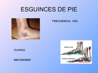 ESGUINCES DE PIE
FRECUENCIA: 10%.
CLINICA
MECANISMO
 