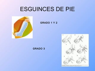 ESGUINCES DE PIE
GRADO 1 Y 2
GRADO 3
 