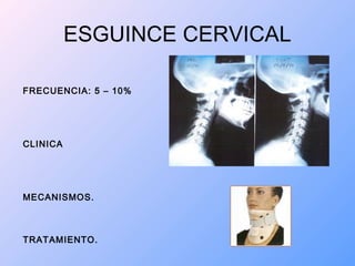 ESGUINCE CERVICAL
FRECUENCIA: 5 – 10%
CLINICA
MECANISMOS.
TRATAMIENTO.
 