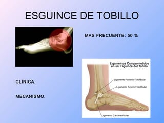 ESGUINCE DE TOBILLO
MAS FRECUENTE: 50 %
CLINICA.
MECANISMO.
 