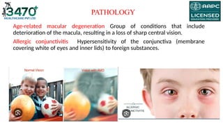 Age-related macular degeneration Group of conditions that include
deterioration of the macula, resulting in a loss of sharp central vision.
Allergic conjunctivitis Hypersensitivity of the conjunctiva (membrane
covering white of eyes and inner lids) to foreign substances.
PATHOLOGY
 