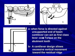 1. forces acting on rpd | PPT