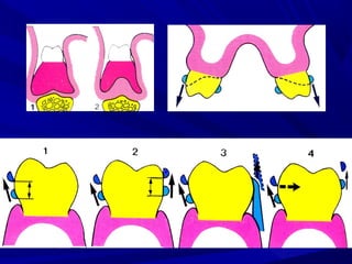 1. forces acting on rpd | PPT