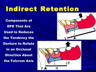 1. forces acting on rpd | PPT
