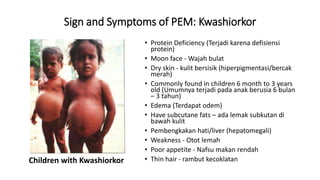 02 Gangguan Akibat KEP Protein Energy Malnutrition 2023.pptx