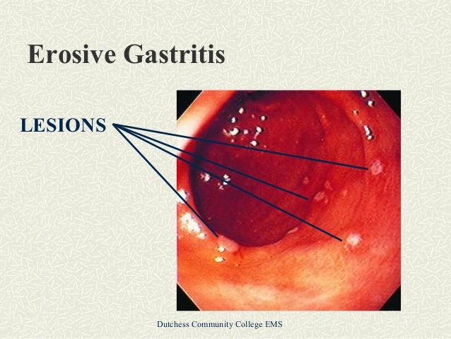Erosive Gastritis Treatment Natural Erosive Gastritis Treatment Natural