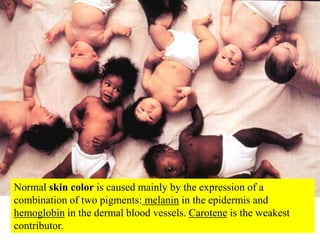 Normal skin color is caused mainly by the expression of a combination of two pigments: melanin in the epidermis and hemogl...