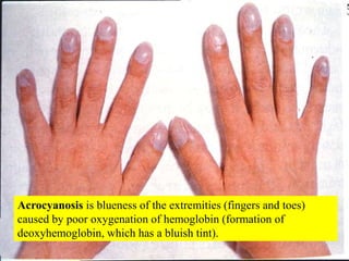 Acrocyanosis is blueness of the extremities (fingers and toes) caused by poor oxygenation of hemoglobin (formation of deox...