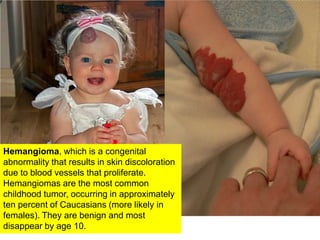 Hemangioma, which is a congenital abnormality that results in skin discoloration due to blood vessels that proliferate. He...