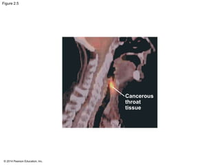 © 2014 Pearson Education, Inc.
Figure 2.5
Cancerous
throat
tissue
 