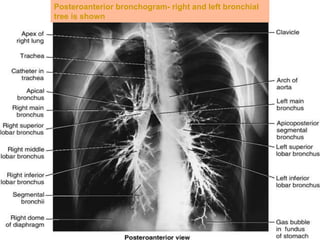 Lungs & Pleura.pptx