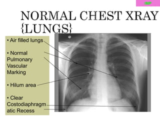 Lungs & Pleura.pptx