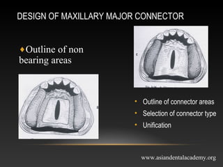 mejor connectors in removable partial dentures | PPT