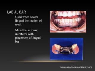 Labial Bar Rpd mejor connectors in removable partial dentures | PPT