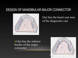 mejor connectors in removable partial dentures | PPT