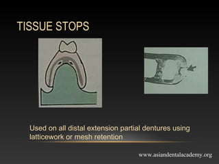 mejor connectors in removable partial dentures | PPT