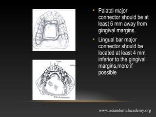 mejor connectors in removable partial dentures | PPT