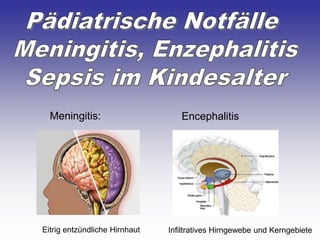 Meningitis: Encephalitis
Eitrig entzündliche Hirnhaut Infiltratives Hirngewebe und Kerngebiete
 