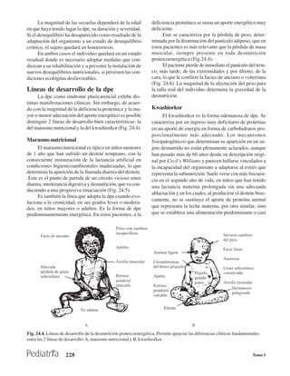 La magnitud de las secuelas dependerá de la edad             deficiencia proteínica se suma un aporte energético muy
en que haya tenido lugar la dpe, su duración y severidad.          deficiente.
Si el desequilibrio ha desaparecido como resultado de la                 Este se caracteriza por la pérdida de peso, deter-
adaptación del organismo a un estado de desequilibrio              minada por la disminución del panículo adiposo, que en
crónico, el sujeto quedará en homeorresis.                         estos pacientes es más relevante que la pérdida de masa
      En ambos casos el individuo quedará en un estado             muscular, siempre presente en toda desnutrición
residual donde es necesario adoptar medidas que con-               proteicoenergética (Fig.24.4).
duzcan a su rehabilitación y a prevenir la instalación de                El paciente pierde de inmediato el panículo del tron-
nuevos desequilibrios nutricionales, si persisten las con-         co, más tarde, de las extremidades y por último, de la
diciones ecológitas desfavorables.                                 cara, lo que le confiere la facies de anciano o volteriana
                                                                   (Fig. 24.6). La magnitud de la afectación del peso para
Líneas de desarrollo de la dpe                                     la talla real del individuo determina la gravedad de la
      La dpe como síndrome pluricarencial exhibe dis-              desnutrición.
tintas manifestaciones clínicas. Sin embargo, de acuer-
do con la magnitud de la deficiencia proteínica y la ma-           Kwashiorkor
yor o menor adecuación del aporte energético es posible                  El kwashiorkor es la forma edematosa de dpe. Se
distinguir 2 líneas de desarrollo bien características: la         caracteriza por un ingreso muy deficitario de proteínas
del marasmo nutricional y la del kwashiorkor (Fig. 24.4).          en un aporte de energía en forma de carbohidratos pro-
                                                                   porcionalmente más adecuado. Los mecanismos
Marasmo nutricional                                                fisiopatogénicos que determinan su aparición en un su-
      El marasmo nutricional es típico en niños menores            jeto desnutrido no están plenamente aclarados, aunque
de 1 año que han sufrido un destete temprano, con la               han pasado más de 60 años desde su descripción origi-
consecuente instauración de la lactancia artificial en             nal por Cecil y Williams y parecen hallarse vinculados a
condiciones higienicoambientales inadecuadas, lo que               la incapacidad del organismo a adaptarse al estrés que
determina la aparición de la llamada diarrea del destete.          representa la subnutrición. Suele verse con más frecuen-
.Este es el punto de partida de un círculo vicioso entre           cia en el segundo año de vida, en niños que han tenido
diarrea, intolerancia digestiva y desnutrición, que va con-        una lactancia materna prolongada sin una adecuada
duciendo a una progresiva emaciación (Fig. 24.5).
                                                                   ablactación y en los cuales, al producirse el destete brus-
      Es también la línea que adopta la dpe cuando evo-
                                                                   camente, no se sustituye el aporte de proteína animal
luciona a la cronicidad, en sus grados leves o modera-
dos, en niños mayores o adultos. Es la forma de dpe                que representa la leche materna, por otro similar, sino
predominantemente energética. En estos pacientes, a la             que se establece una alimentación predominante o casi




Fig. 24.4. Líneas de desarrollo de la desnutrición proteicoenergética. Permite apreciar las diferencias clínicas fundamentales
entre las 2 líneas de desarrollo: A, marasmo nutricional y B, kwashiorkor.


                     228                                                                                                  Tomo I
 