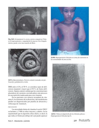 Fig. 24.9. Avitaminosis A, severa, xerosis conjuntival. Nóte-
se el engrosamiento y sequedad de la mucosa. En el ángulo
interno, puede verse una mancha de Bitot.




                                                                24.9B. Hiperqueratosis folicular en zonas de extensión en
                                                                las extremidades de una escolar.




24.9 A. Queratomalacia. Xerosis corneal avanzada con per-
foración y pérdida de la visión.


DRR entre el 20 y el 50 %, se considera signo de defi-
ciencia marginal y mayor que el 50 %, de franca defi-
ciencia. Algunos autores señalan que las concentraciones
plasmáticas de carotenos son indicadores más precoces
de una nutrición inadecuada para esta vitamina.
     En los pacientes con carencia secundaria de vita-
mina A, los trastornos de la absorción y del metabolismo
pueden ser diagnosticados por pruebas de absorción y
sobrecarga de vitaminaA.
PREVENCIÓN
      Las necesidades diarias de vitamina A son de 1500 U
en lactantes y 2 000 en niños mayores y adultos. Se ha
argumentado que la ingestión crítica diaria, es decir, la        24.9.C. Nótese la hipertrofia de los folículos pilosos
que indica el límite por debajo del cual puede aparecer         (hiperqueratosis folicular tipo I).


Parte V. Alimentación y nutrición                                                                    237
 