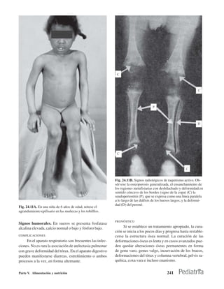 Fig. 24.11B. Signos radiológicos de raquitismo activo. Ob-
                                                            sérvese la osteoporosis generalizada, el ensanchamiento de
                                                            los regiones metafisiarias con deshilachado y deformidad en
                                                            sentido cóncavo de los bordes (signo de la copa) (C) la
                                                            seudoperiostitis (P), que se expresa como una línea paralela
                                                            a lo largo de las diáfisis de los huesos largos; y la deformi-
                                                            dad (D) del peroné.
Fig. 24.11A. En una niña de 6 años de edad, nótese el
agrandamiento epifisario en las muñecas y los tobilllos.

                                                            PRONÓSTICO
Signos humorales. En sueros se presenta fosfatasa
alcalina elevada, calcio normal o bajo y fósforo bajo.            Si se establece un tratamiento apropiado, la cura-
                                                            ción se inicia a los pocos días y progresa hasta restable-
COMPLICACIONES                                              cerse la estructura ósea normal. La curación de las
     En el aparato respiratorio son frecuentes las infec-   deformaciones óseas es lenta y en casos avanzados pue-
ciones. No es rara la asociación de atelectasia pulmonar    den quedar alteraciones óseas permanentes en forma
con grave deformidad del tórax. En el aparato digestivo     de genu varo, genus valgo, incurvación de los brazos,
pueden manifestarse diarreas, estreñimiento o ambos         deformaciones del tórax y columna vertebral, pelvis ra-
procesos a la vez, en forma alternante.                     quítica, coxa vara e incluso enanismo.


Parte V. Alimentación y nutrición                                                               241
 